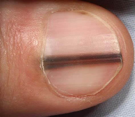 melanoma in fingernail bed